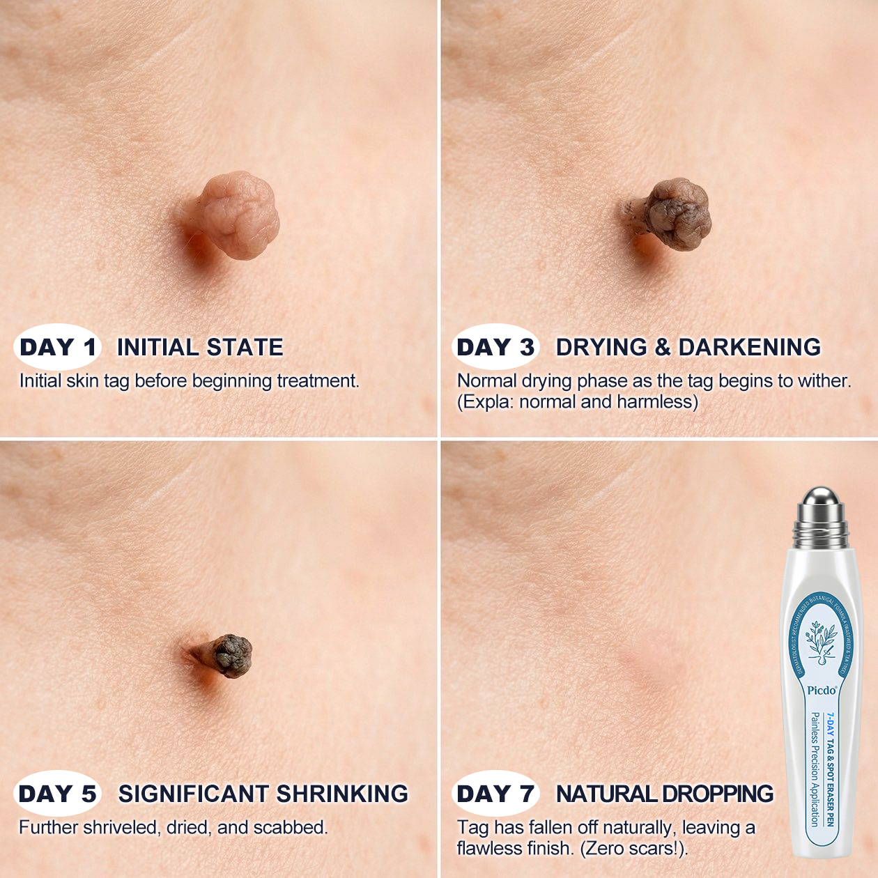 𝐏i𝐜𝐝o®🍁💖 7-𝐷𝑎𝑦 𝗧𝐚𝐠 & 𝗦𝗽𝐨𝐭 𝐄𝐫𝒂𝒔𝒆𝒓(Zero Pain, Zero 𝐒𝐜𝐚𝒓𝒔 Rollerball)