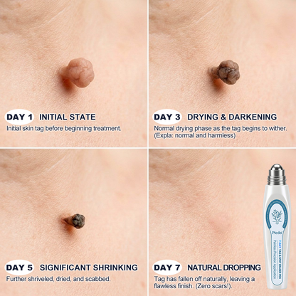 𝐏i𝐜𝐝o®🍁💖 7-𝐷𝑎𝑦 𝗧𝐚𝐠 & 𝗦𝗽𝐨𝐭 𝐄𝐫𝒂𝒔𝒆𝒓(Zero Pain, Zero 𝐒𝐜𝐚𝒓𝒔 Rollerball)